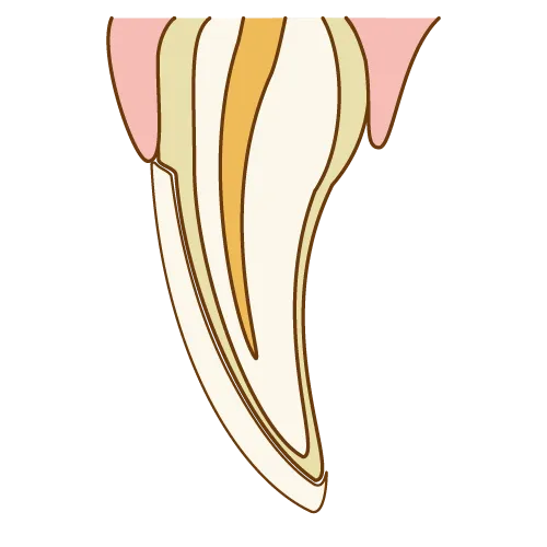 ラミネートベニア手順03