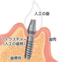 インプラントの構造