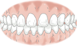 空隙歯列（くうげきしれつ）