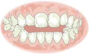 開咬(かいこう)