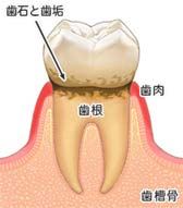歯周病の構造