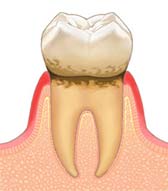 軽度(歯肉炎)