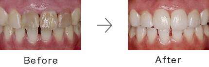 ホワイトニング症例1