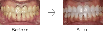 ホワイトニング症例3