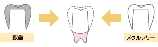 メタルフリー治療
