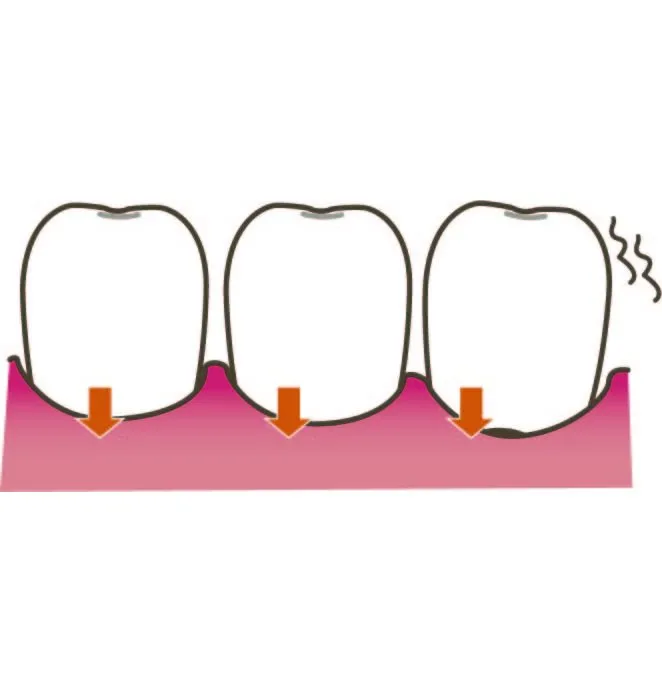 歯肉退縮が起こる