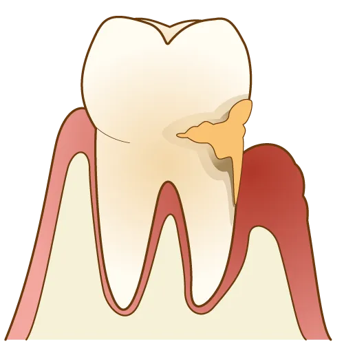 虫歯リスクが高まる