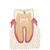 イラスト図：虫歯C1