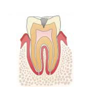 イラスト図：虫歯C2