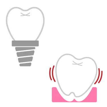 インプラントと歯