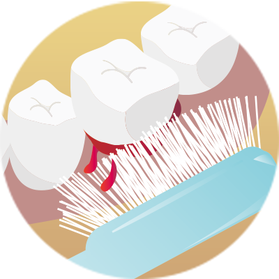 ハブラシで歯茎から血がでる