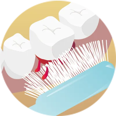 ハブラシで歯茎から血がでる