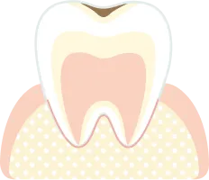 エナメル質の虫歯