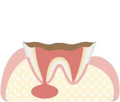 歯の上部がほとんど残っていない虫歯