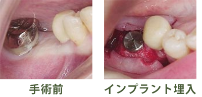 手術前・インプラント埋入