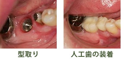 型取り・人工歯の装着