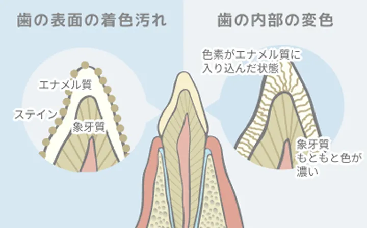 歯が黄色く見えるのはなぜ？